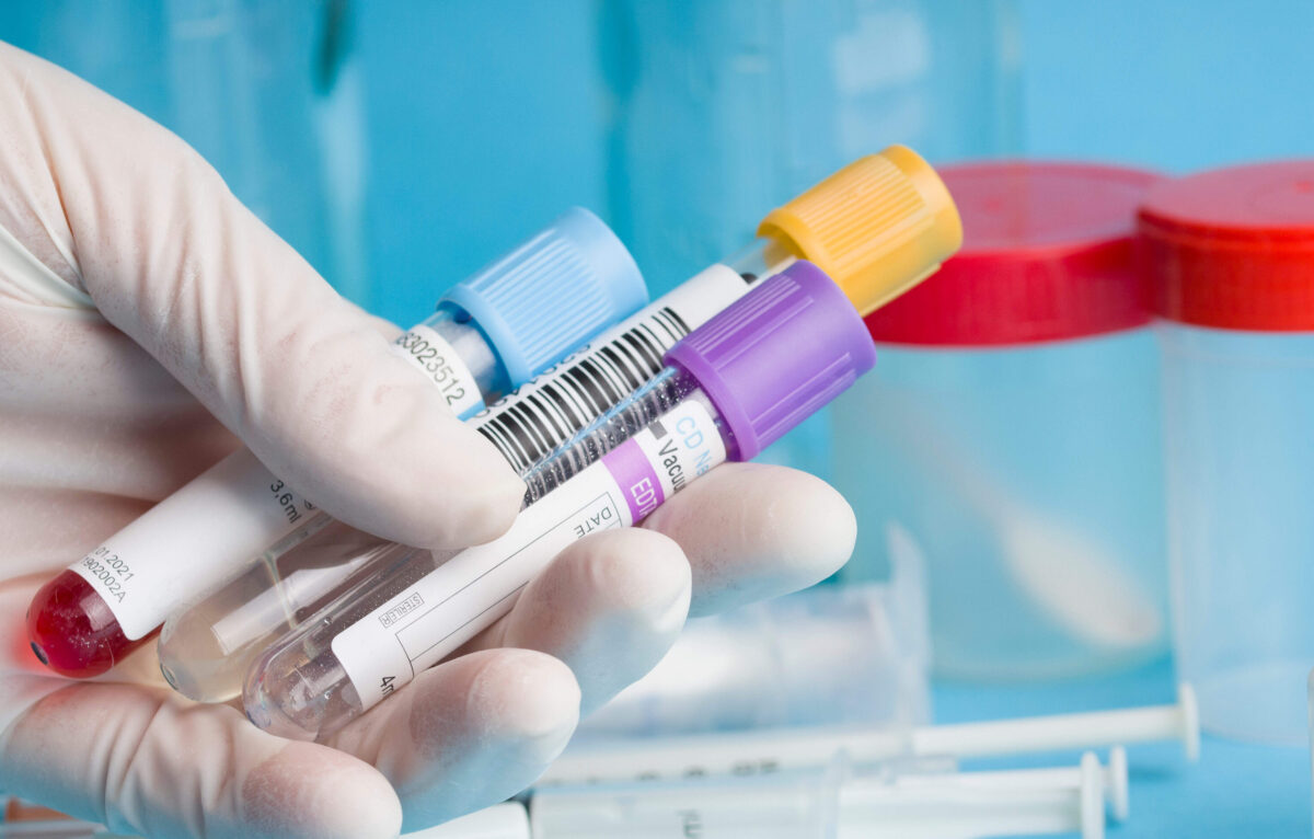 Un’analisi del sangue riconosce 5 tumori 4 anni prima
